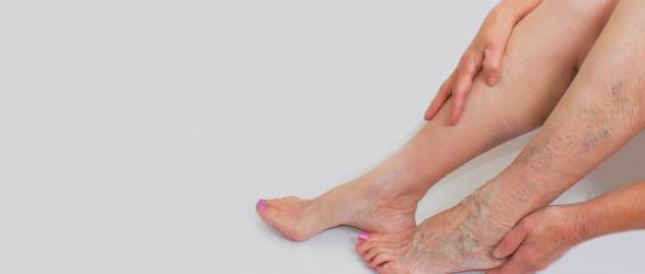 Oteklé nohy, křeče a drobné metličky nejsou kosmetický problém, ale projevem žilního onempocnění. Odstranění metliček onemocnění nevyřeší.