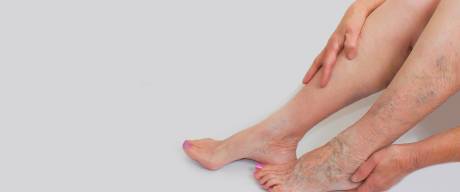 Oteklé nohy, křeče a drobné metličky nejsou kosmetický problém, ale projevem žilního onempocnění. Odstranění metliček onemocnění nevyřeší.